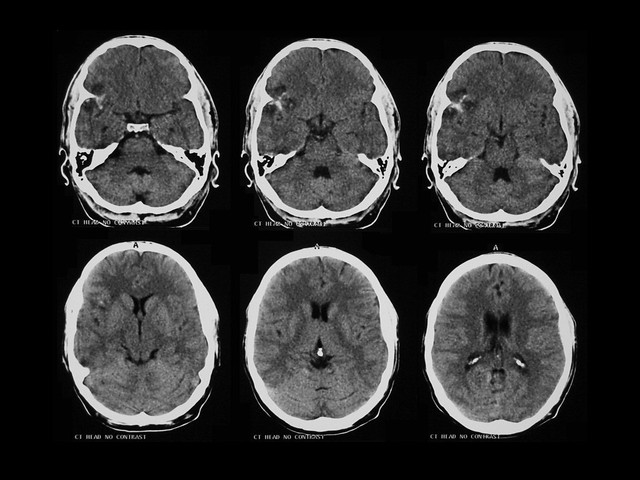 Cerebral contusion from head trauma - any other visible in… | Flickr