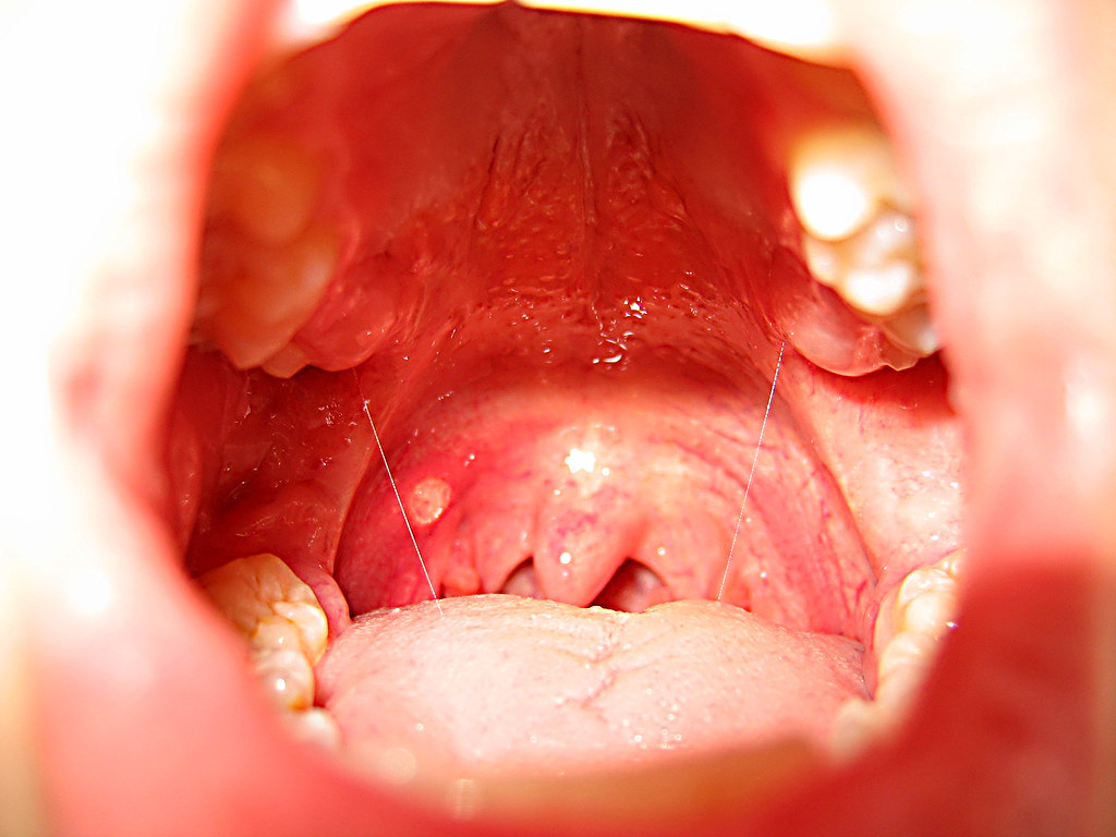 painful-bump-on-tongue-farelasopa