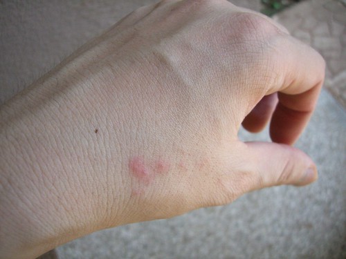 Bed bug bite first day | Flickr - Photo Sharing!