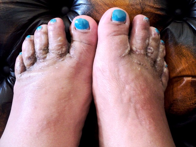 Foot Infections: Background, Soft-Tissue Infections in ...