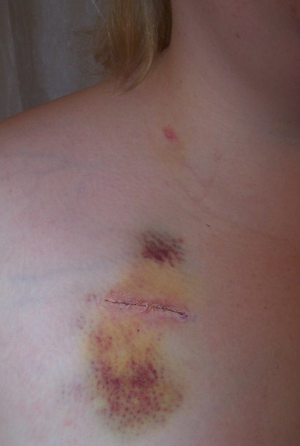 Chemo Port Scar | Under the bandages... My right shoulder wh… | Flickr