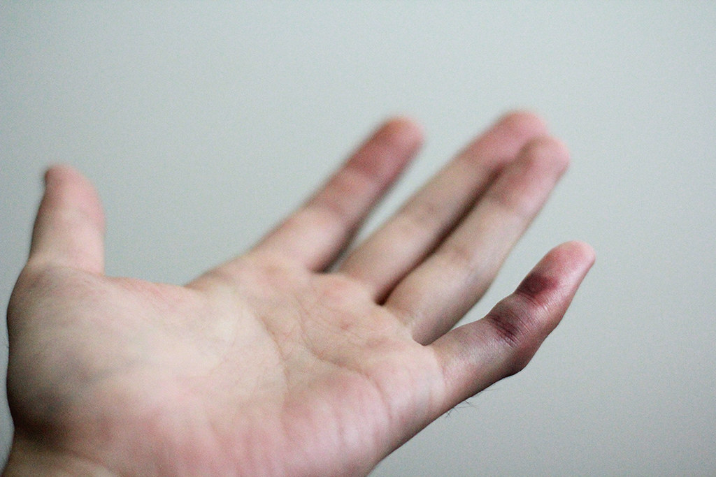 6-10-2010 pinky finger - day-2 | -RYAN | Flickr

