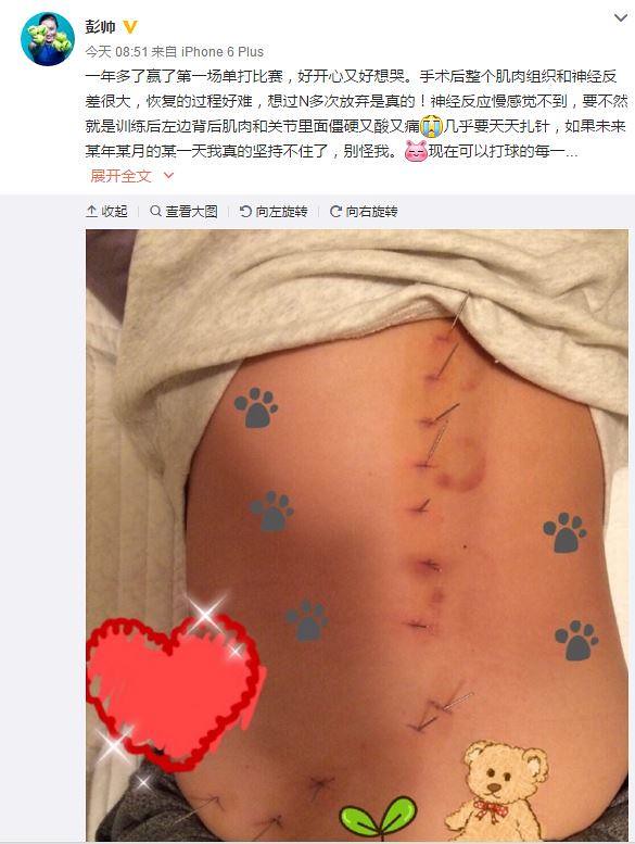Tied a week 300 needles, surgical suture ten centimeters, Peng shuai was women's tennis Golden last stubborn