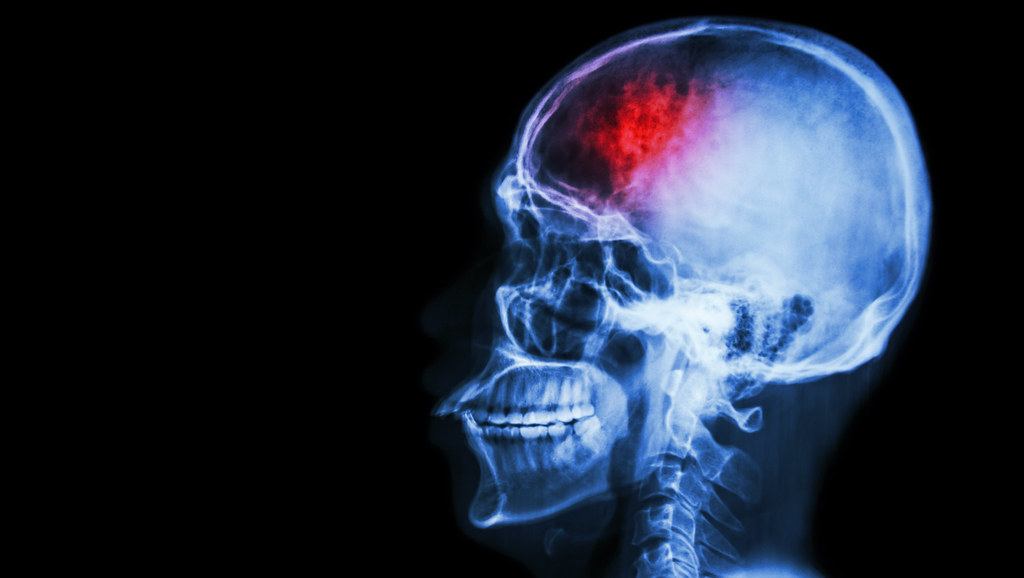 X ray image of skull showing red pain in brain area