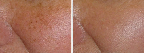 完美的除斑對策，完美的除斑科技，美上美的除斑雷射技術是業界第一，利用最新的除斑雷射，幫您消除斑點，皮膚美白。美上美的除斑療程，給您有最有感的除斑效果。