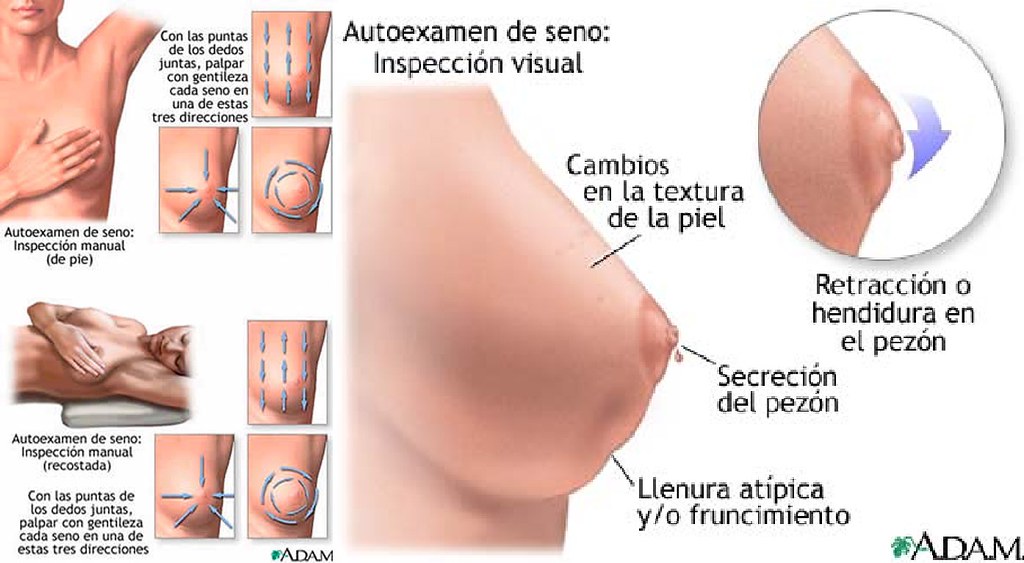 síntomas del cáncer de mama