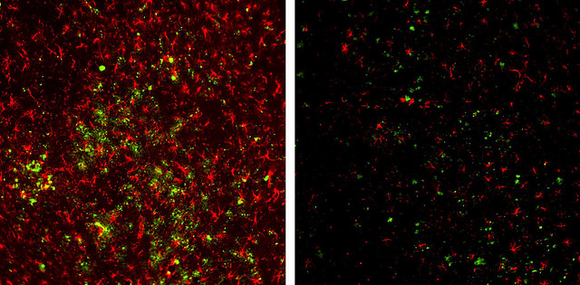 Images highlight the effect of treatment on amyloid-beta plaques and neuro-inflammation found in a brain with signs of Alzheimer’s. 