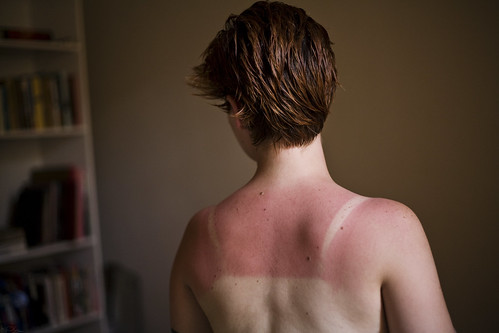 It's the time of year for unexpected sunburns