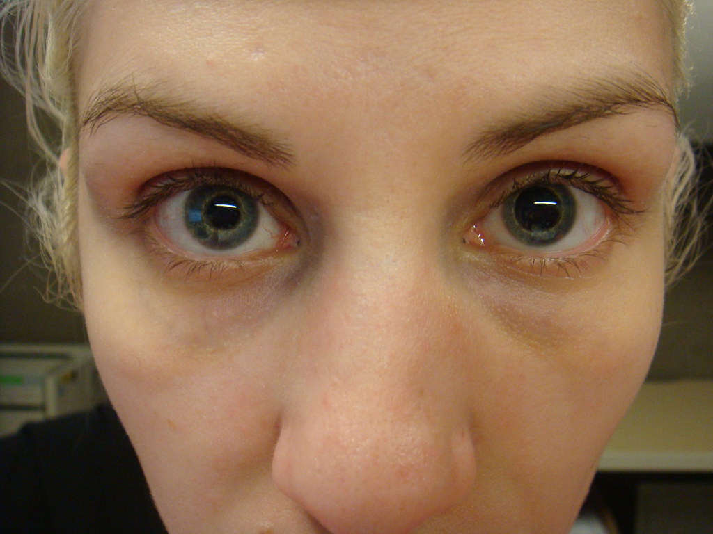 unequal pupil size following a head injury