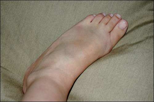 foot-bruise-1 | how does one bruise their foot this badly an… | Flickr