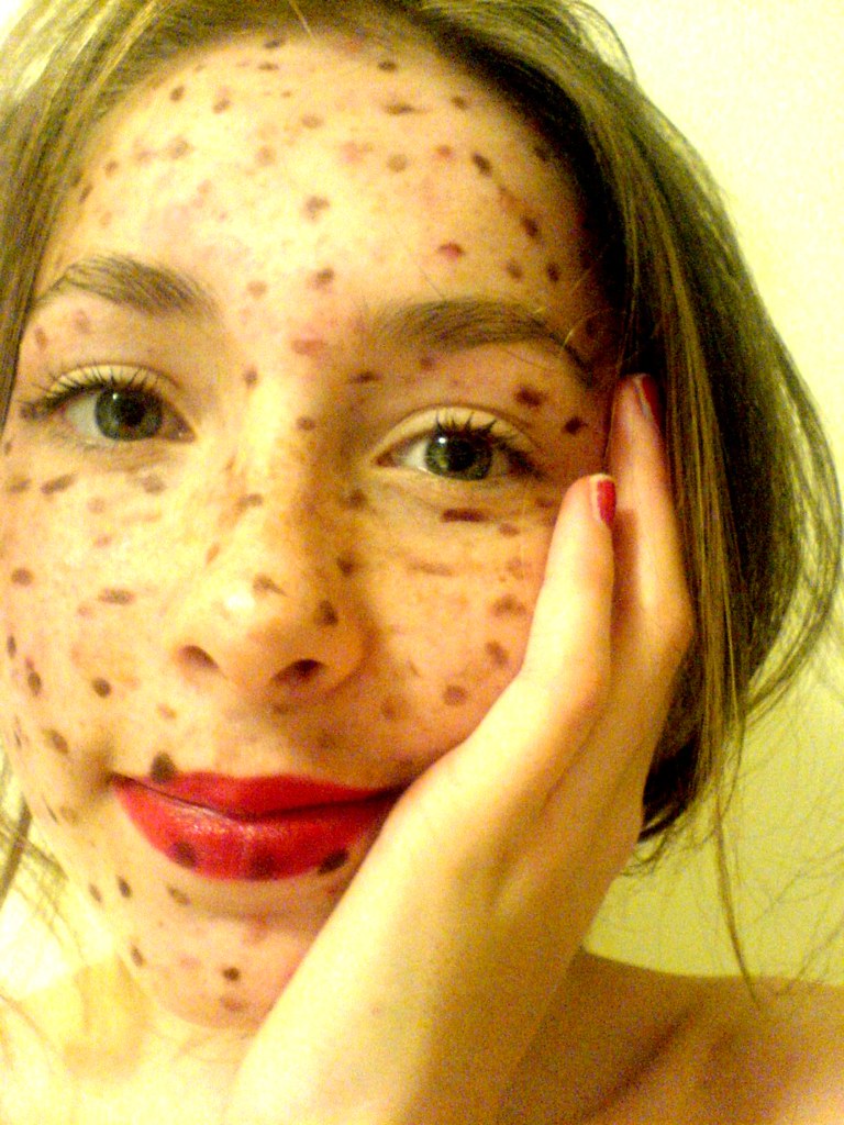 new freckle on face #10
