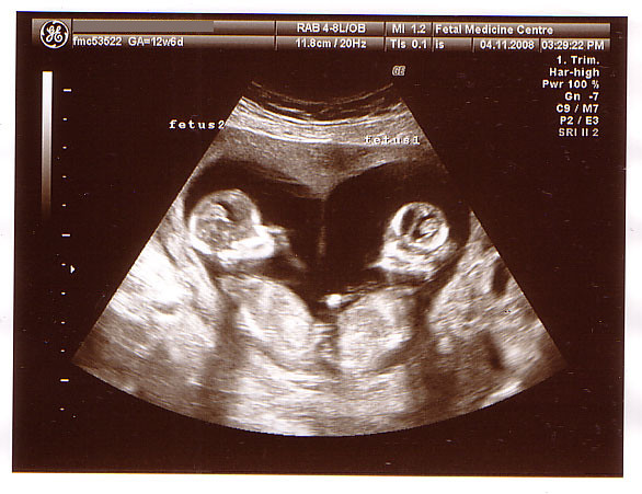 Twins - 12 Week Scan (Heart shaped) | Its official, there's … | Flickr