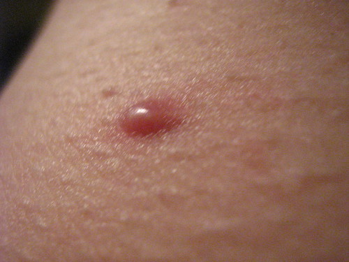 Is this bump herpes? - STDs - MedHelp