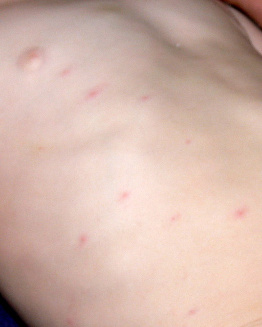 viral skin rash #11