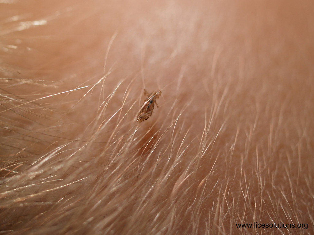 Head Lice - Female Louse On Hair Zoomed In On | A female lou… | Flickr