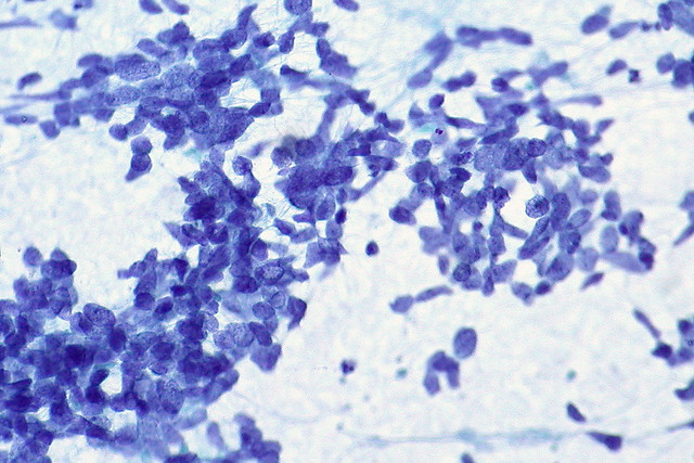 Small Cell Carcinoma, Pleural FNA | Immunostains performed o… | Flickr