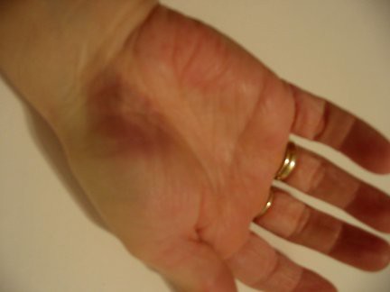 Hand Bruise | I remember this one. Before a drills class, we… | Flickr
