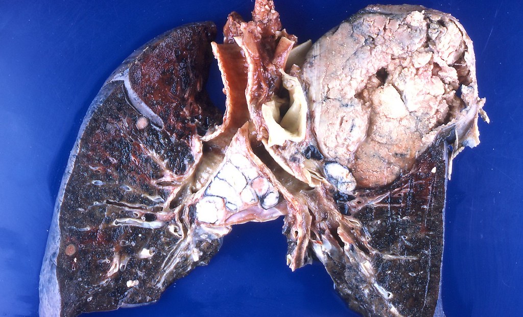 Lungenkrebs Kind