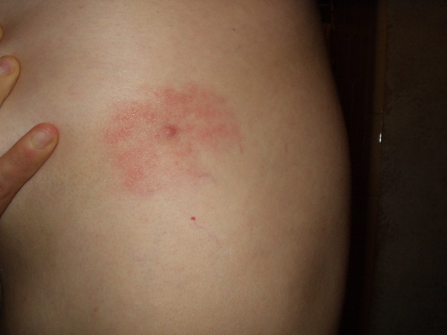 rash-around-tick-bite-flickr-photo-sharing