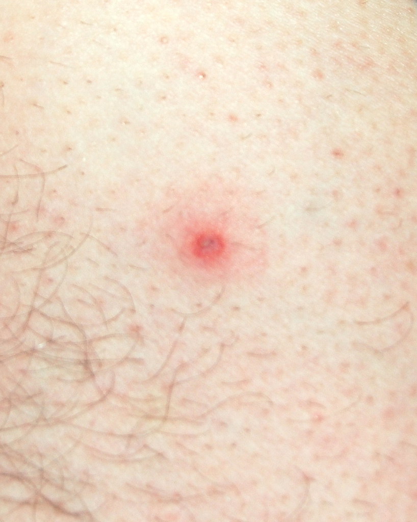 Lyme Disease Becomes Personal A Tick Bite Can Change Thing Flickr