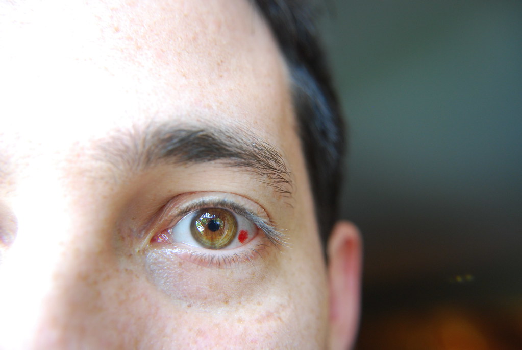 burst-blood-vessel-in-eye-burst-blood-vessel-in-eye-4-days-flickr