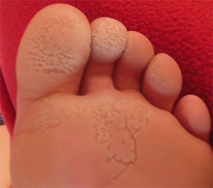 Bacterial Infections of the Feet and Toes - Verywell