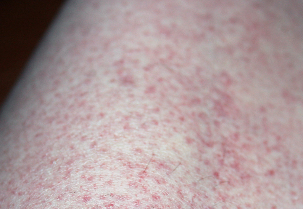 Skin Rash 3 Skin Rash Due To Taking Sulfasalazine For Thre Flickr 3258