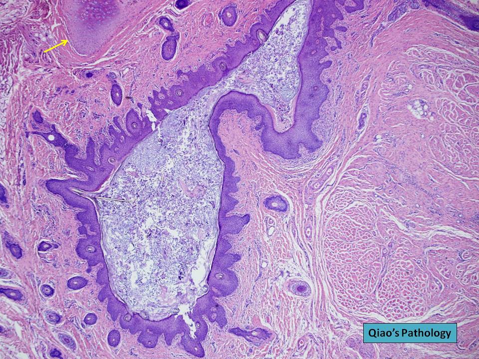 Qiao's Pathology: First Branchial Cleft Cyst Type 2 | Flickr