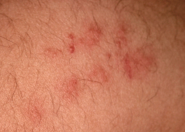 Bed Bug Bite on Arm | Flickr - Photo Sharing!