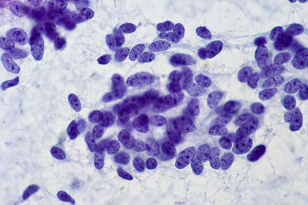 Carcinoid tumor - FNA Case 169 | CONTRIBUTED BY ED UTHMAN, M… | Flickr