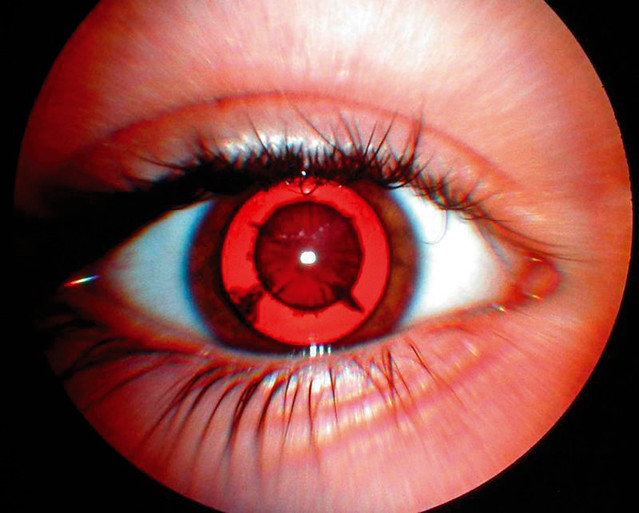 Cyclopentolate ophthalmic : uses, side effects 