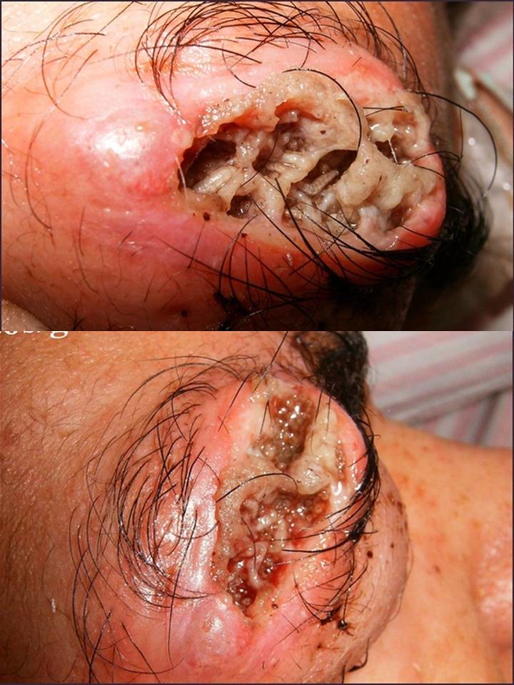 skin cancer on face pictures #11