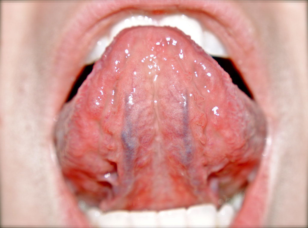 herpes under tongue #10