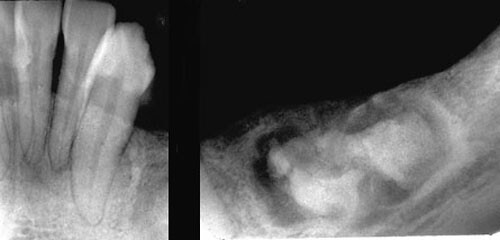 central cementifying fibroma