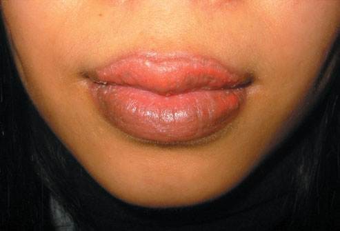 Allergic to Lip Products? - Allergy - MedHelp