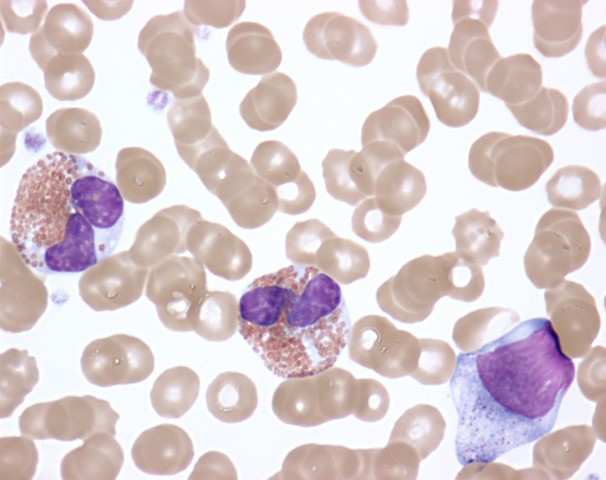 Activated Eosinophils In Idiopathic Hypereosinophilic Synd Flickr