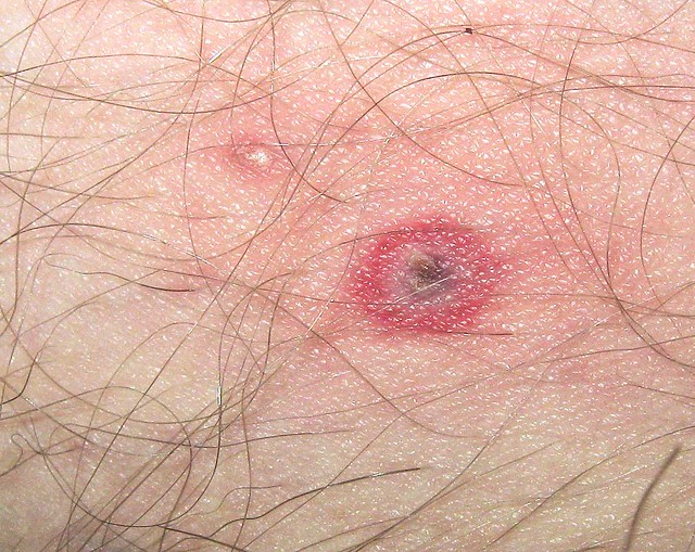 Symptoms of Tickborne Illness | Ticks | CDC