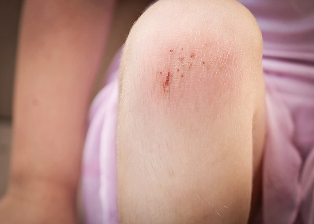 Em's scraped knee | Flickr - Photo Sharing!