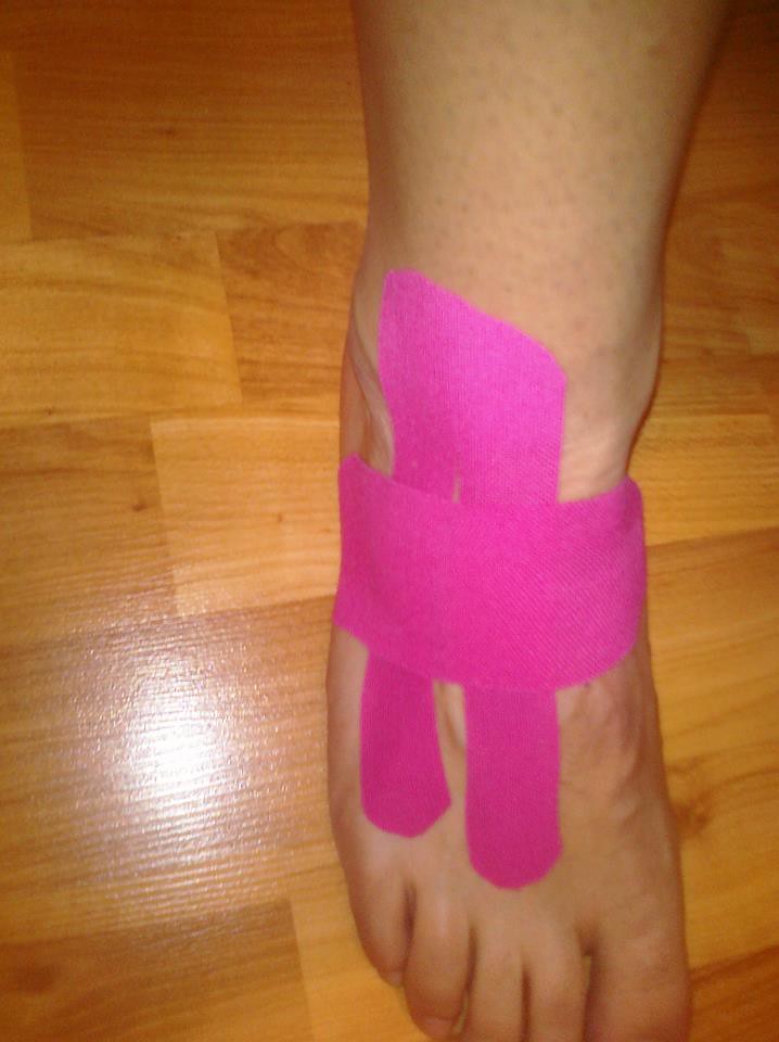 KT Tape for lateral foot pain (inferior extensor retinacul… | Flickr
