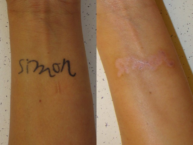 Laser tattoo removal by dermatologist Dr. Joel Schlessinger | Flickr ...