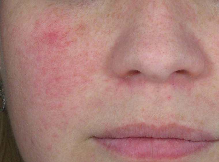 Types Of Rosacea Bumps And Pimples Rosacea Can Often Be C Flickr