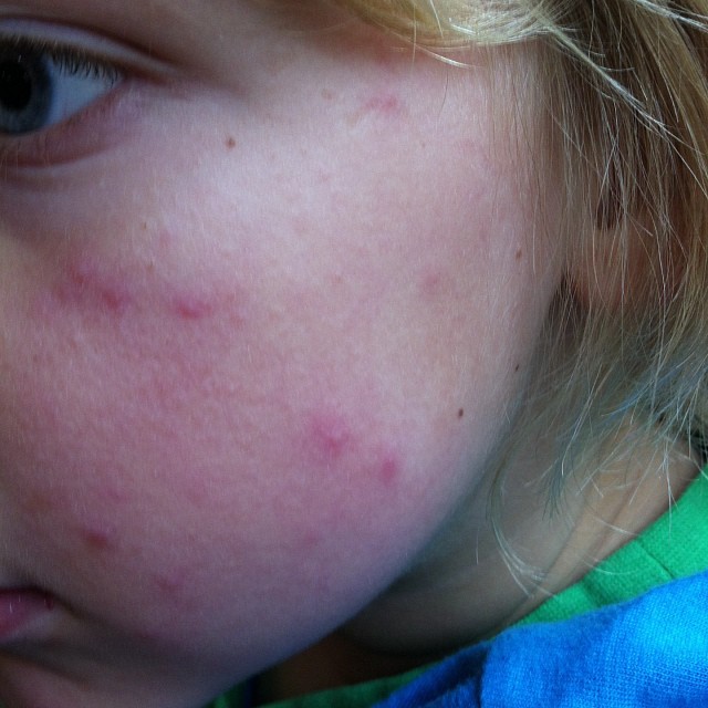 early chicken pox pictures
