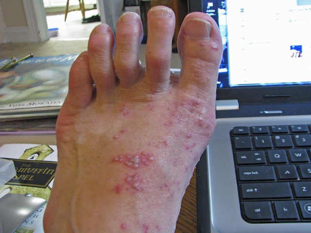 shingles on foot | Flickr - Photo Sharing!