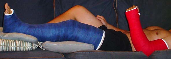 Long Leg Cast (LLC) & Long Arm Cast (LAC) | fcaster8 | Flickr