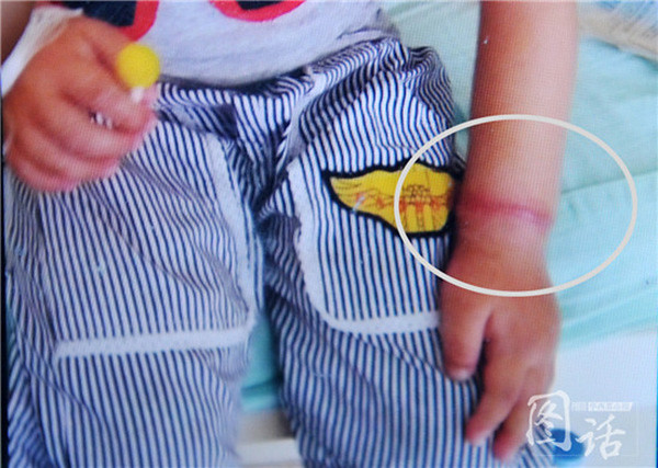 A boys ' wrist band 3 parents in Sichuan province were found, by repeatedly discharging cannot bend